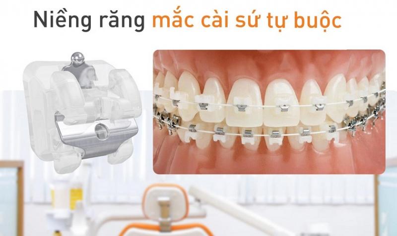 Các loại niềng rắng mắc cài sứ dây trong