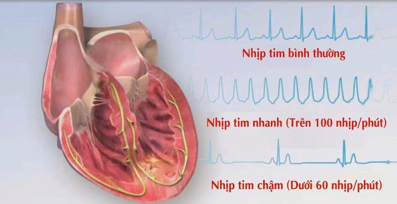 Các loại rối loạn nhịp tim