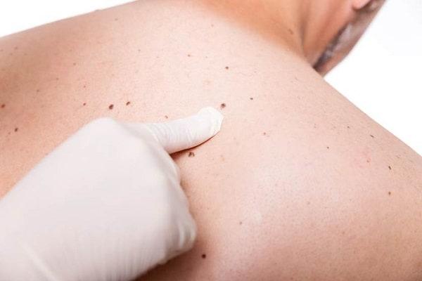 Điều trị ung thư da và các tổn thương da tiền ung thư được biết đến như actinic keratoses khác nhau, tùy thuộc vào kích thước, độ sâu, loại và vị trí của tổn thương.