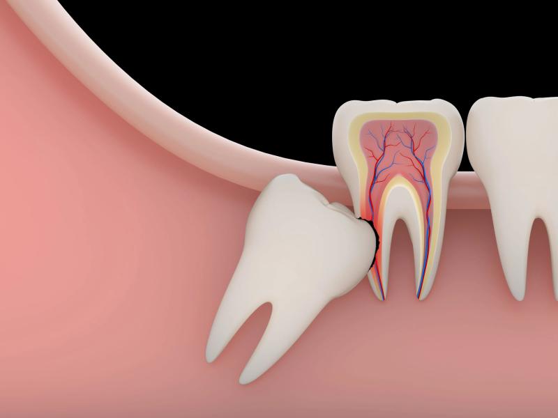 Các trường hợp cần nhổ răng