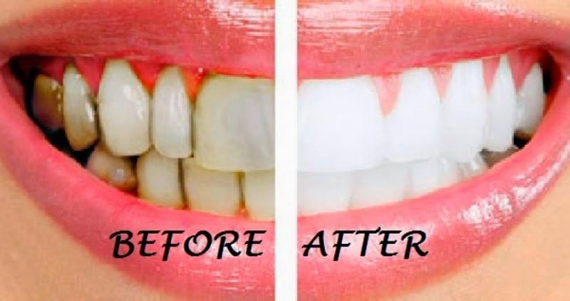 Top 17 Cách làm đẹp răng tự nhiên, trắng sáng hiệu quả nhất
