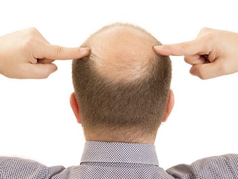 Trị hói đầu bằng thuốc tây y