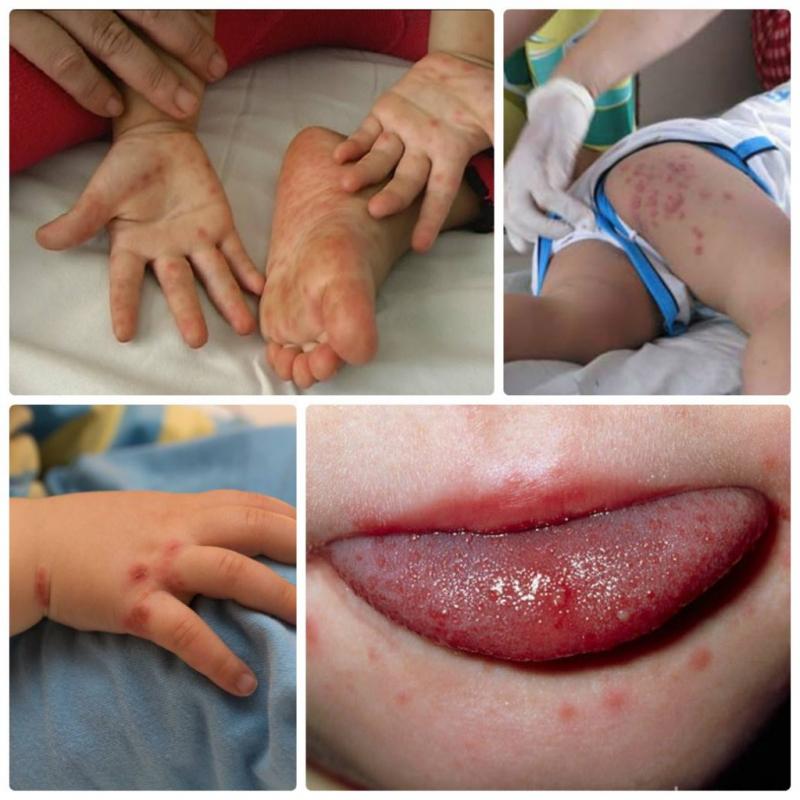Các bé bị tay chân miệng do virus EV71 thường sẽ có những biểu hiện bệnh lý nghiêm trọng