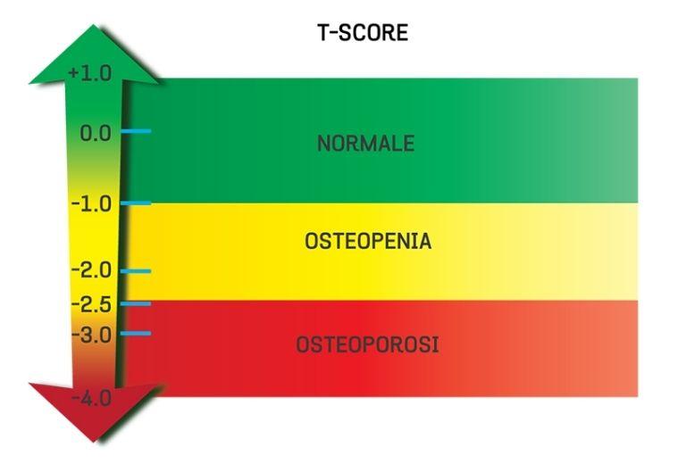 Tiêu chuẩn chẩn đoán bệnh loãng xương