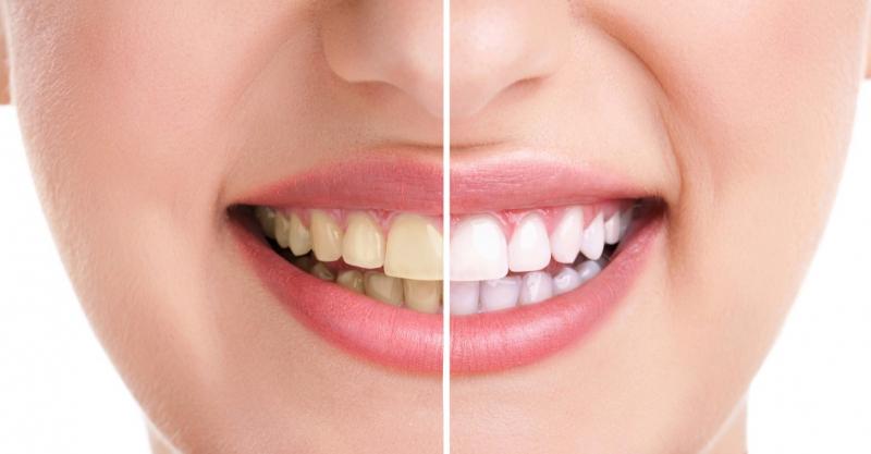 Chanh và các loại quả có tính axit cao gây sâu răng, làm mòn men răng