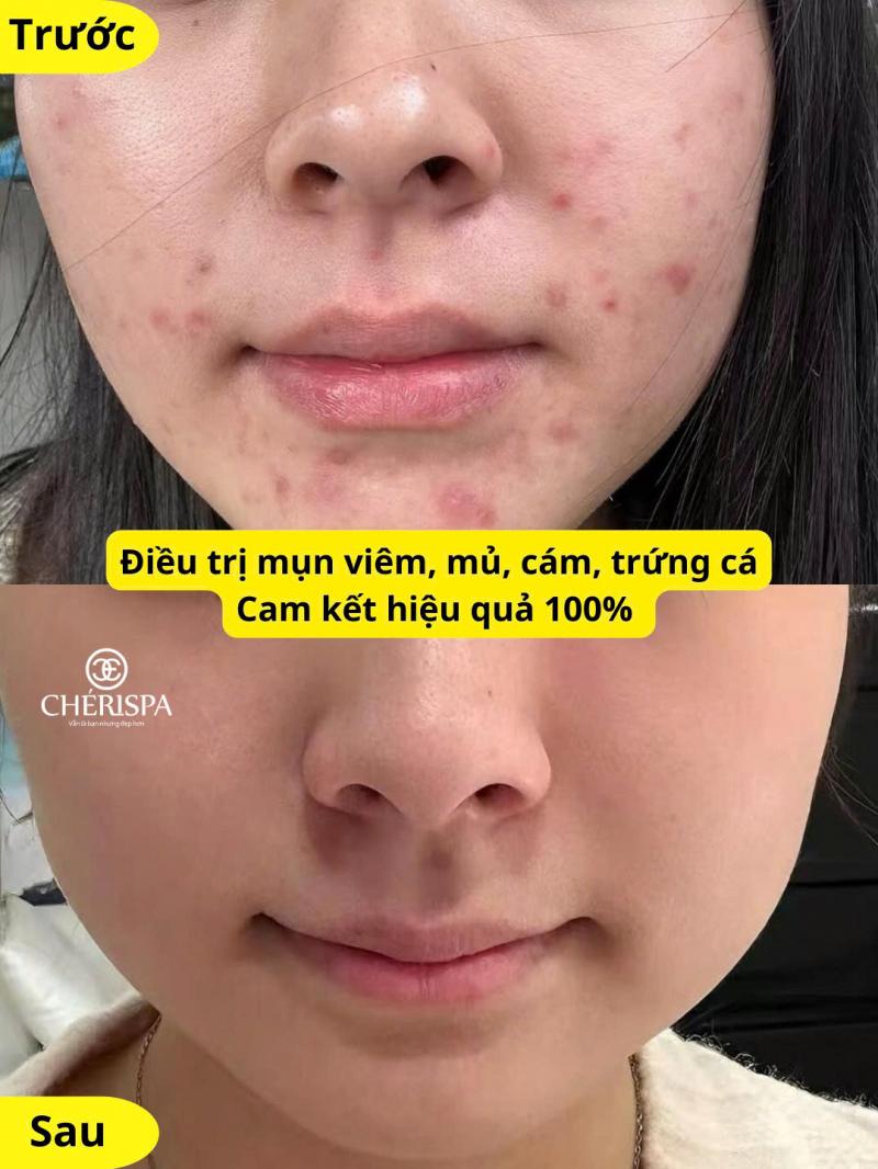 Chérispa Quảng Ngãi - Spa Trị Mụn Hiệu Quả, Chuẩn Y Khoa