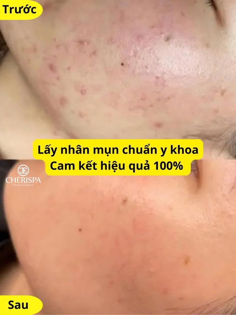 Chérispa Quảng Ngãi - Spa Trị Mụn Hiệu Quả, Chuẩn Y Khoa