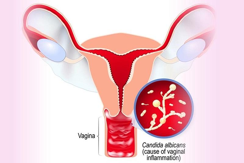 Sản phẩm chỉ định trong trường hợp nhiễm Candida âm đạo