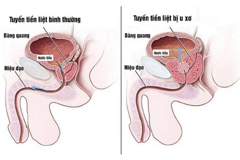 Không sử dụng sản phẩm cho bệnh nhân đang mắc bệnh u xơ tuyến tiền liệt