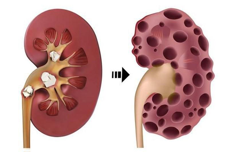 Chống chỉ định trong trường hợp bệnh nhân suy thận nặng