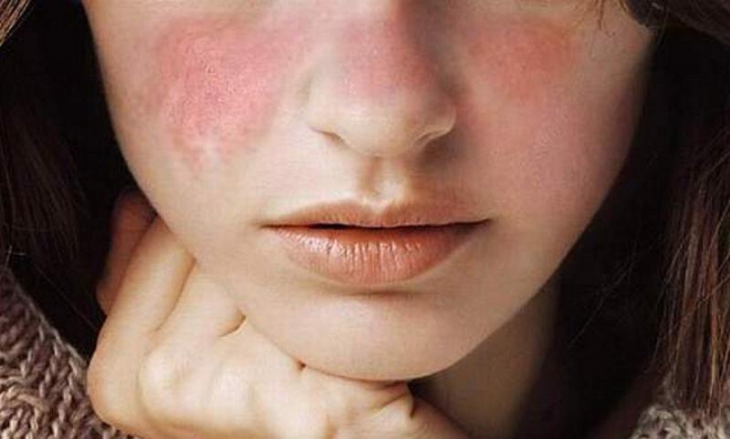 Sản phẩm chỉ định cho bệnh nhân mắc hội chứng hội chứng Sjogren