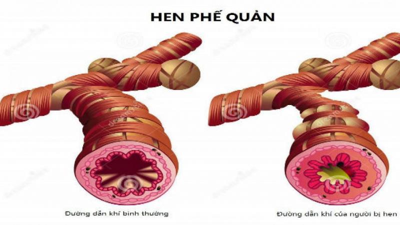 Không sử dụng sản phẩm cho người bị hen phế quản