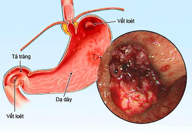 Sản phẩm chống chỉ định của người loét dạ dày