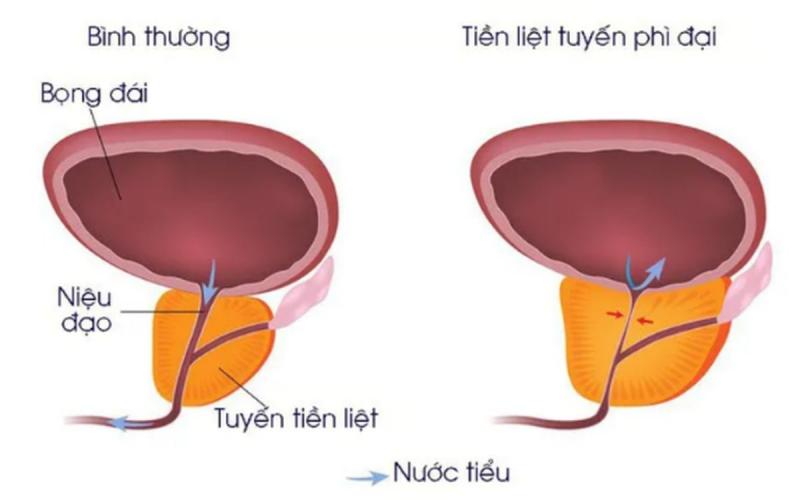 Người bệnh có triệu chứng phì đại tuyến tiền liệt