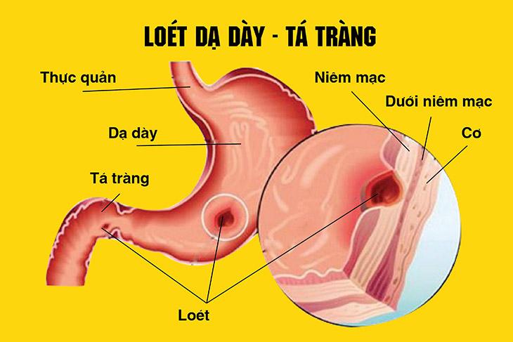 Không sử dụng sản phẩm đối với bệnh nhân loét dạ dày - tá tràng