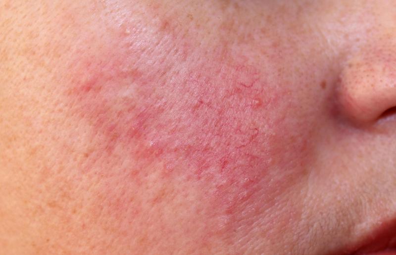 Chống chỉ định cho những trường hợp bệnh trứng cá đỏ Rosacea