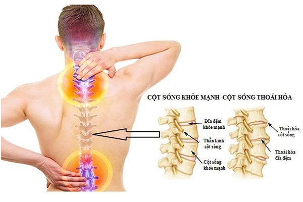 PGS.TS.BS Cao Thỉ - Chuyên gia khám chữa thoái hóa cột sống đầu ngành