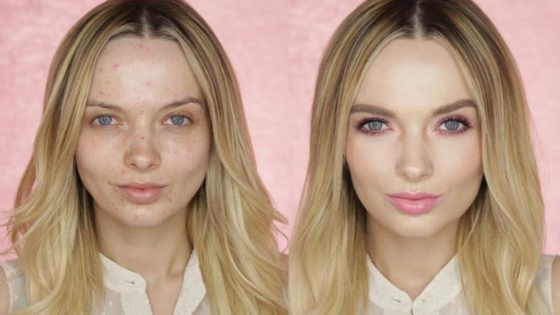 Tình trạng da mặt trước và sau khi sử dụng Clinique Acne Solutions Clearing