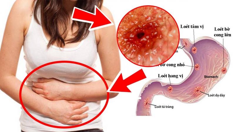 Sản phẩm có tác dụng điều trị viêm dạ dày cấp và mãn tính