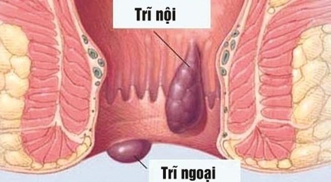 Hình ảnh trĩ nội, trĩ ngoại