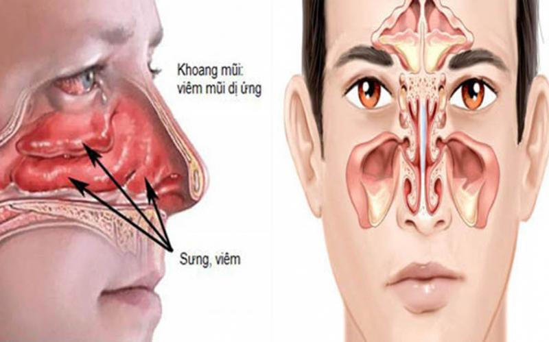 Chỉ định cho viêm mũi dị ứng mùa và quanh năm