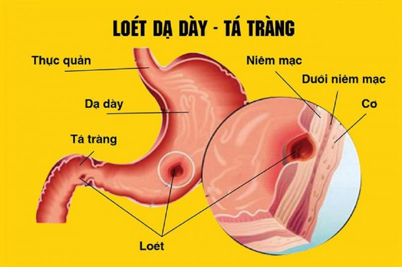 Sản phẩm Viprazo được dùng trong bệnh lý loét dạ dày