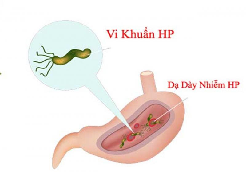 Sản phẩm kháng sinh có tác dụng diệt vi khuẩn kỵ khí