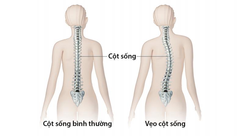 Cong vẹo Cột sống