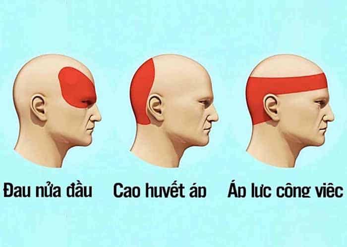 Đau đầu là biểu hiện của tăng huyết áp