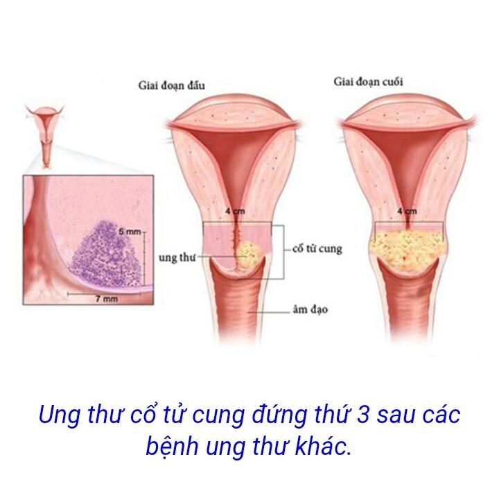 Ung thư cổ tử cung ở nữ giới