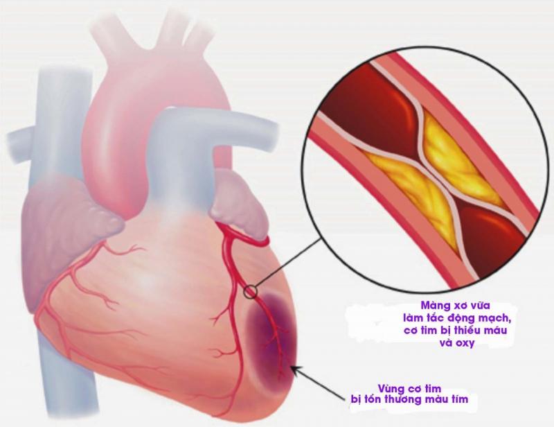 Dấu hiệu nhận biết nhồi máu cơ tim