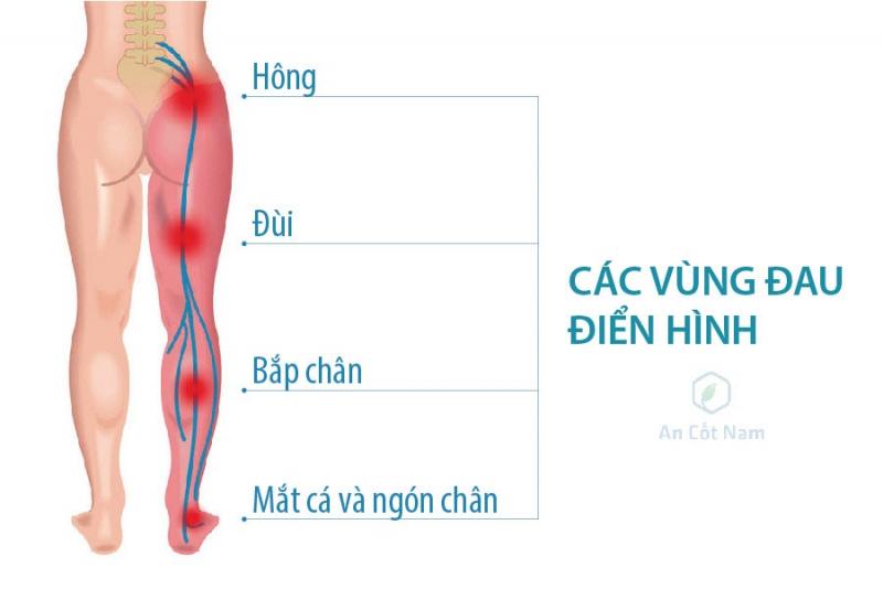 Triệu chứng đau thần kinh tọa