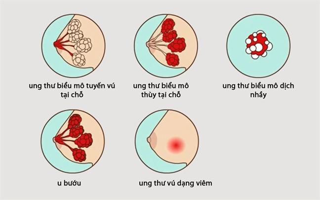 Dịch tiết bất thường ở vú