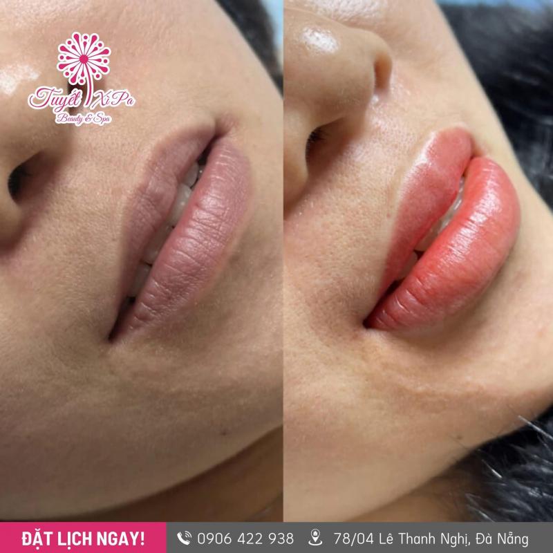 Dịch vụ khử thâm môi của Tuyết Xì Pa