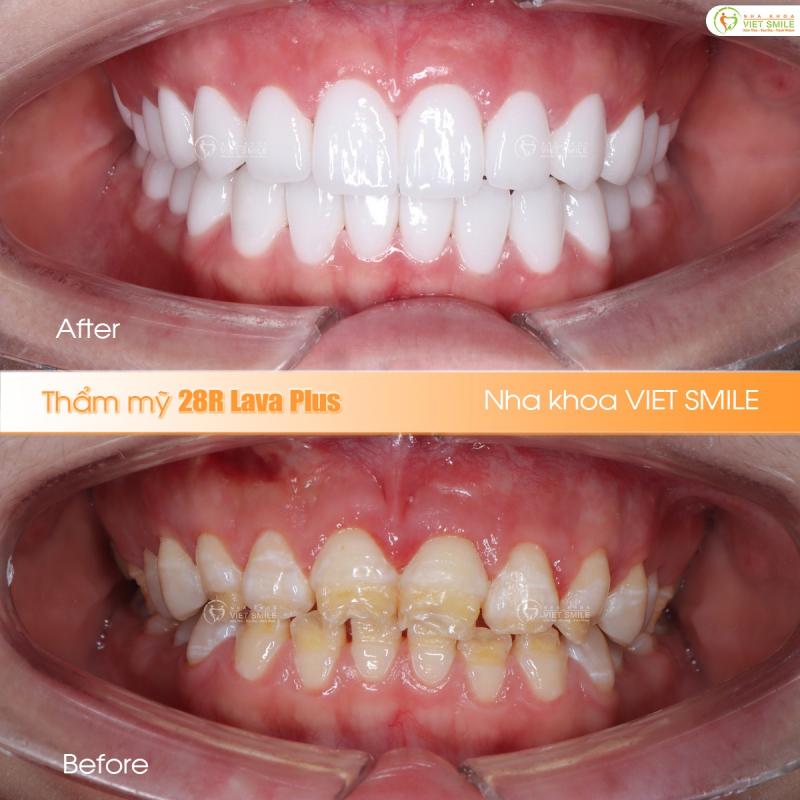 Nha khoa Vi﻿﻿ệt Smile