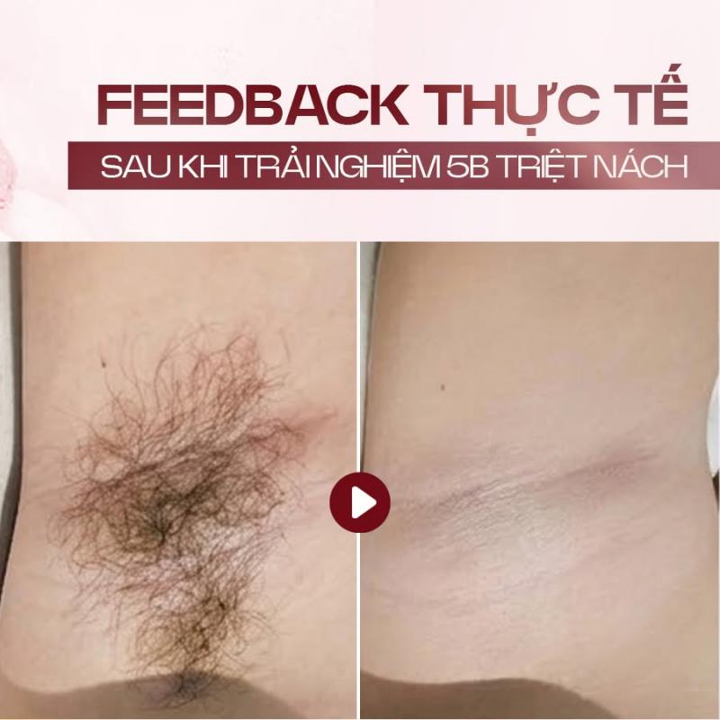 Dịch vụ triệt lông tại YB Spa
