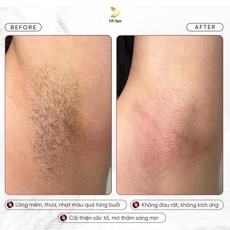 Dịch vụ triệt lông tại YB Spa