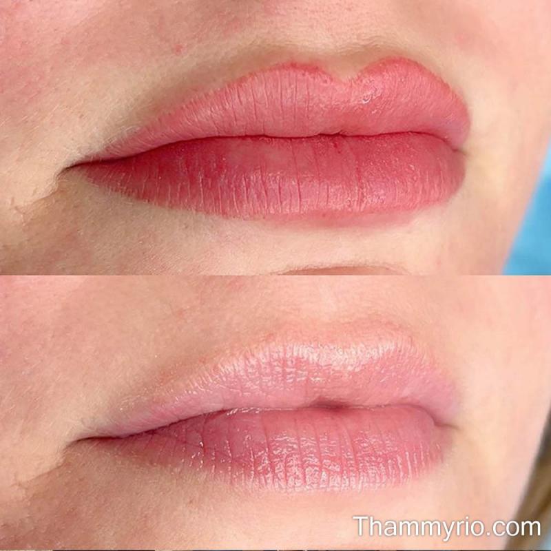 Dịch vụ xóa xăm môi tại Thẩm mỹ Rio Beauty Clinic