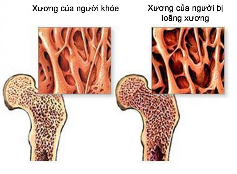 hình ảnh xương của người thiếu canxi, loãng xương so với người bình thường