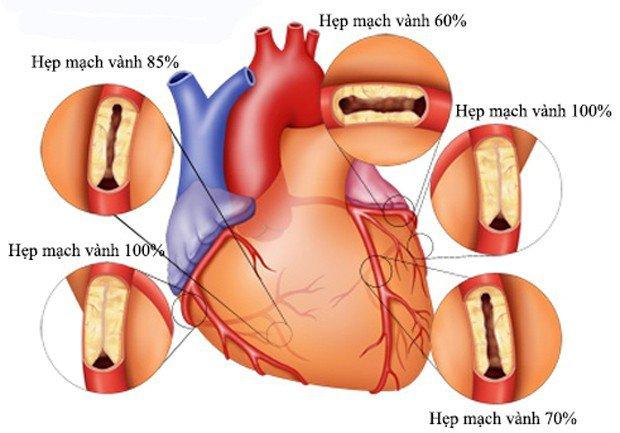 Các phương pháp hiệu quả điều trị bệnh mạch vành