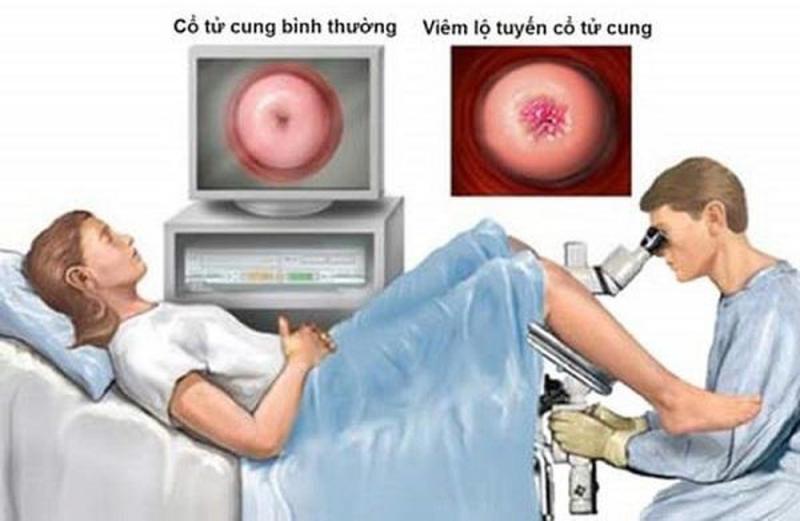 Điều trị viêm lộ tuyến tử cung