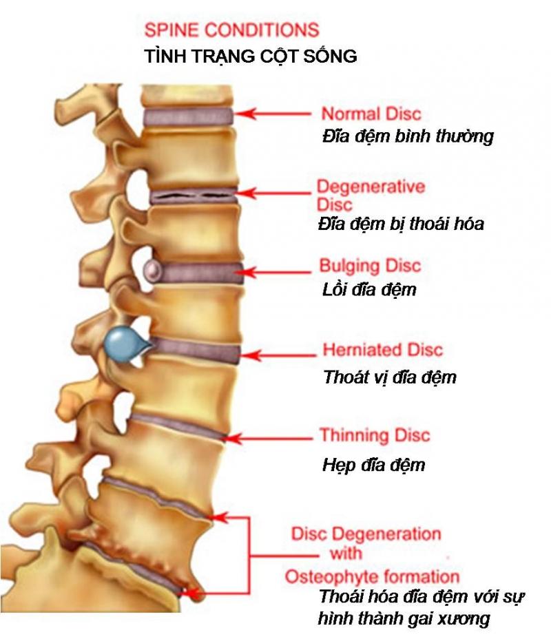 Thoái hoá do tự nhiên