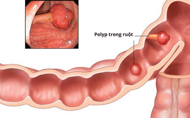 Người bị polip đại tràng dễ mắc bệnh