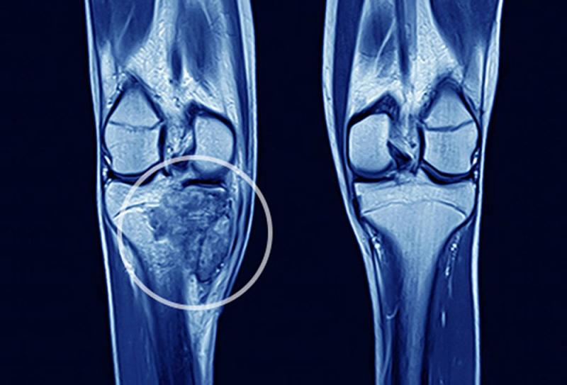 ﻿Sarcoma xương