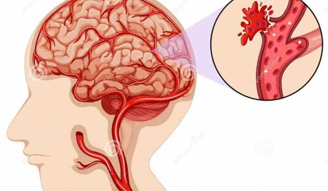 Loại bệnh khi ăn tối muộn