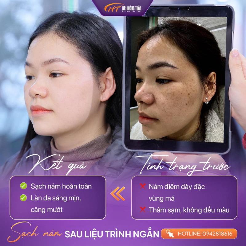 Dr Hoàng Tuấn Hà Nội - Trị Nám Tàn Nhang Không Bong Tróc, Không Tái Phát Uy Tín Hà Nội