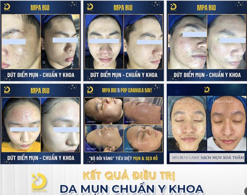 Dr.Choice Clinic – Chuyên trị mụn, nặn mụn, lấy nhân mụn uy tín ở TpHCM