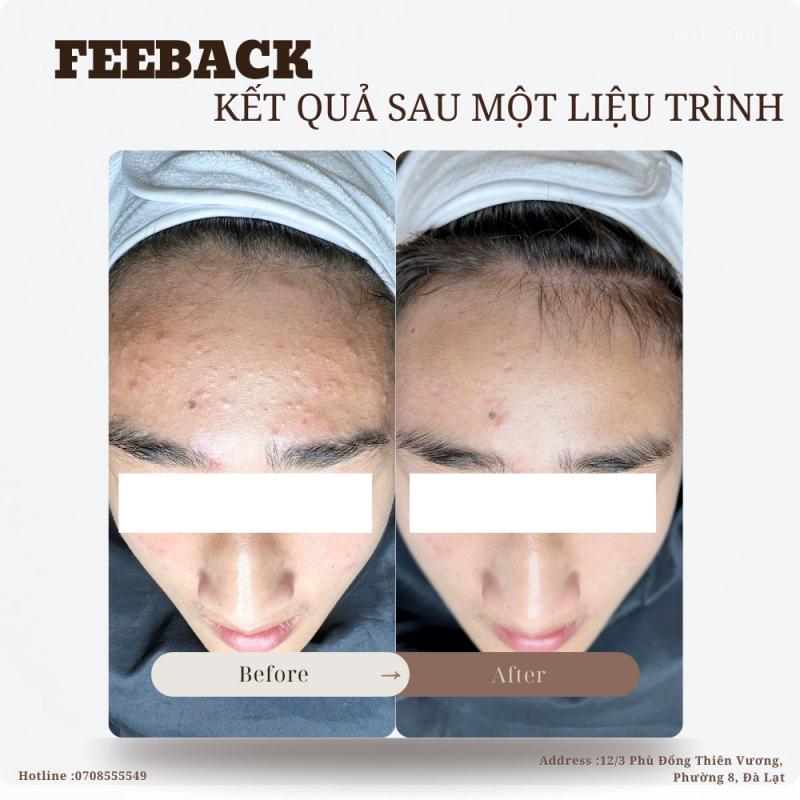 Dung Nhi Beauty Spa - Spa Trị Mụn Uy Tín, An Toàn