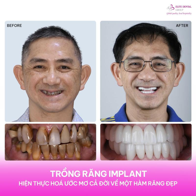 Elite Dental - Nha khoa trồng răng Implant và Phục hình kĩ thuật số