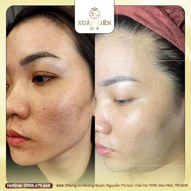 Ellen Spa - Trung tâm điều trị da giải quyết nỗi phiền não về việc trị mụn của bạn